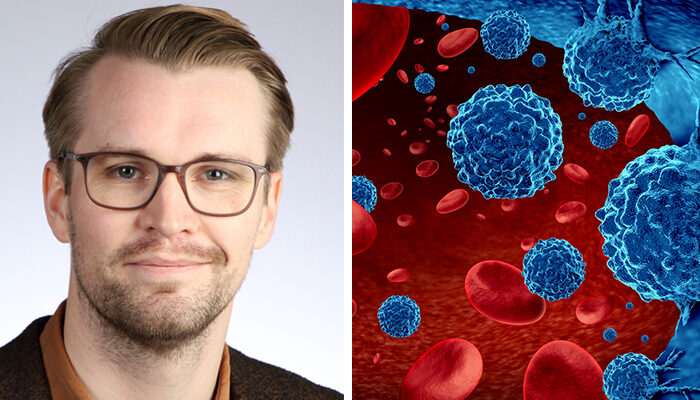 Icelandic study changes the definition of multiple myeloma precursor condition